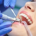 Beyond Aesthetics: The Importance Of Professional Teeth Cleaning